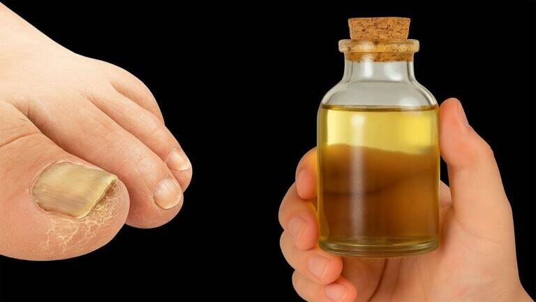 This simple home remedy transforms nail fungus in days… discover how to say goodbye!