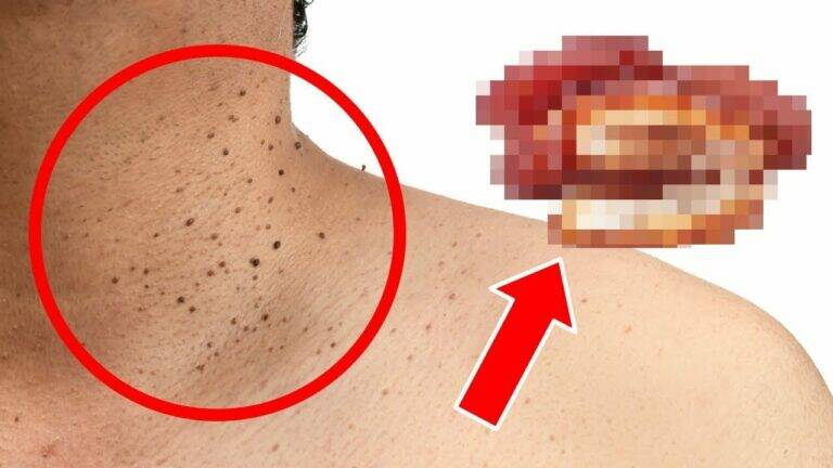 This simple change in your diet could help eliminate stubborn skin tags forever…