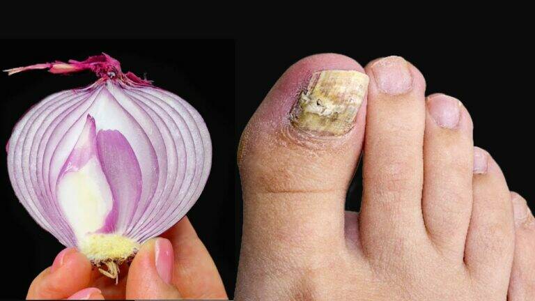 This simple remedy eliminates nail fungus… and it’s completely natural!