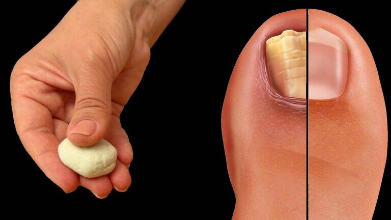 This simple remedy transforms nail fungus using just three common ingredients…