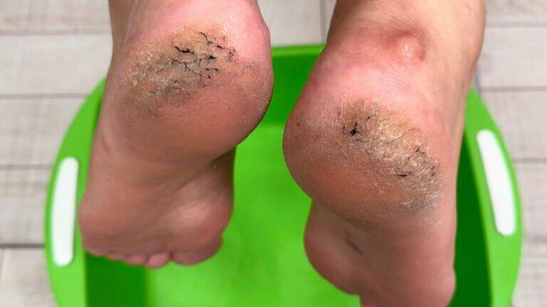 An old trick to transform cracked heels into baby-soft feet in just minutes…